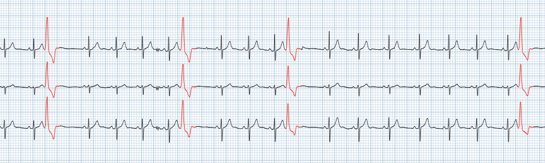 Comparison of Lead I from Smartwatch ECG versus Conventional Lead I from 12-Lead ECG