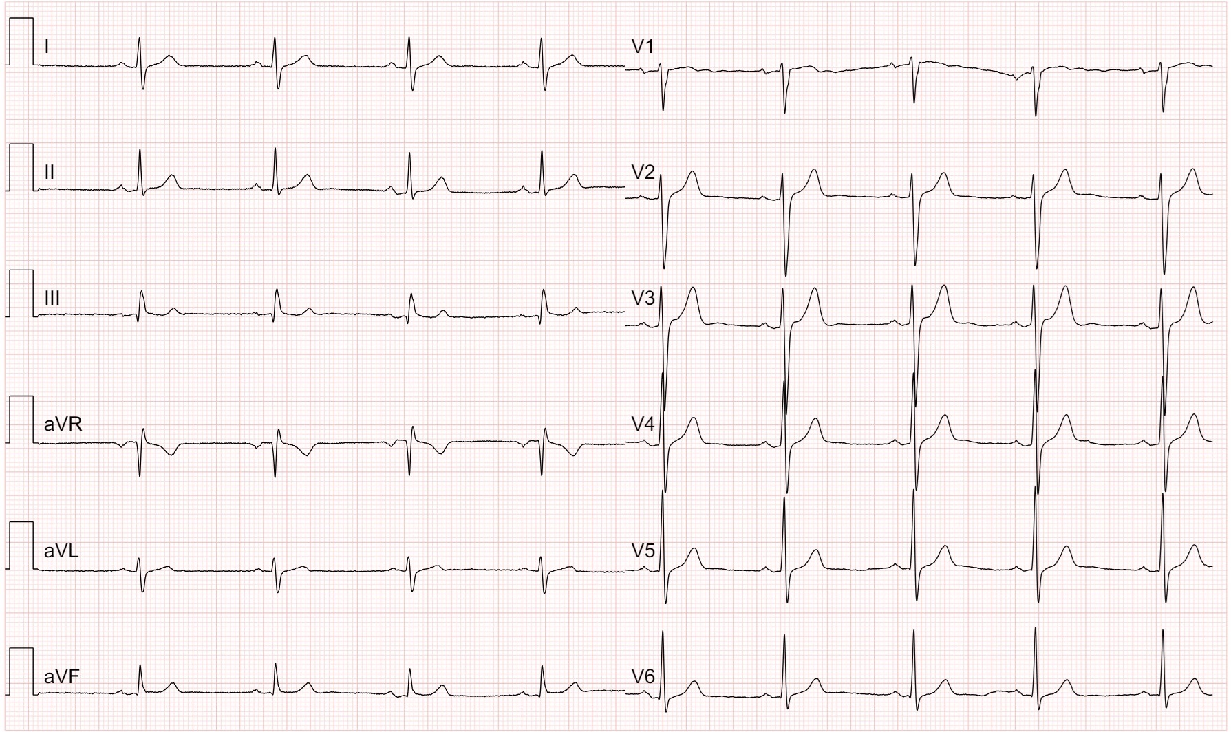 Comparison of Lead I from Smartwatch ECG versus Conventional Lead I from 12-Lead ECG